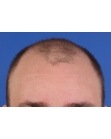 Before Hair Transplant &nbsp;Front